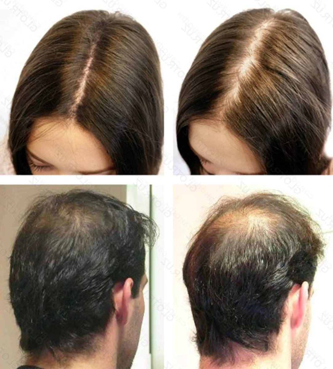 Сильный рост волос. Андрогенная алопеция миноксидил. Андрогенная алопеция Гамильтон. Андрогенная алопеция трихоскопия. Мезотерапия волос до и после.