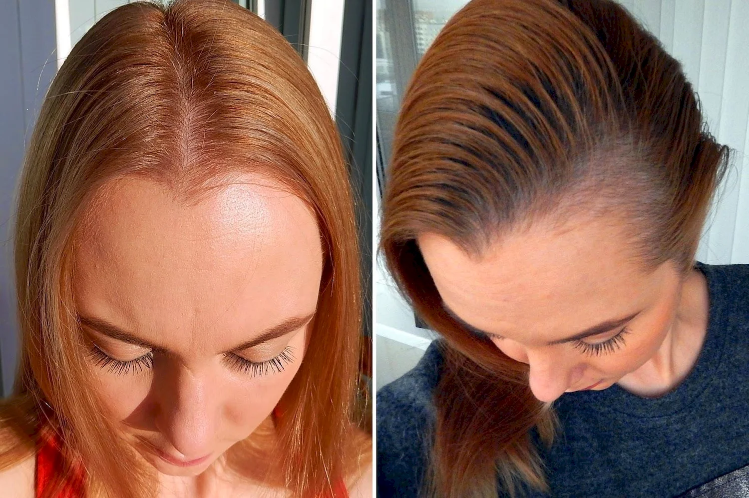 Дарсонваль для волос до и после
