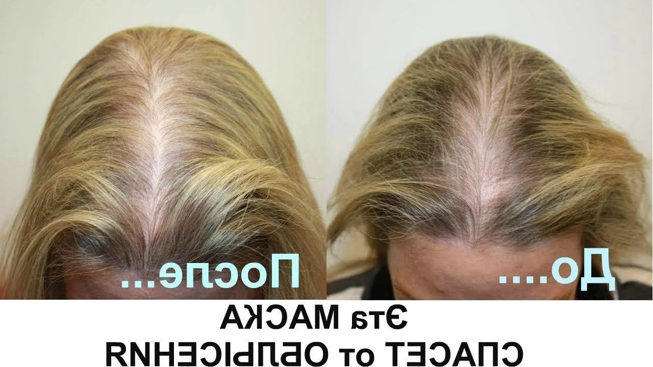 До и после мезотерапии волос