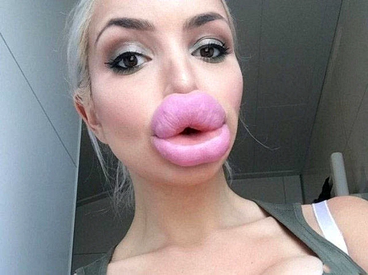 Перекаченные губы у девушки фото