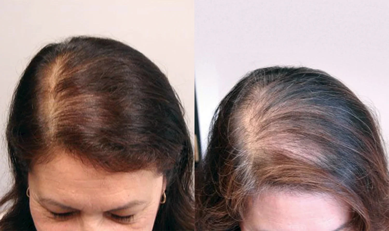 Hair before after hair loss