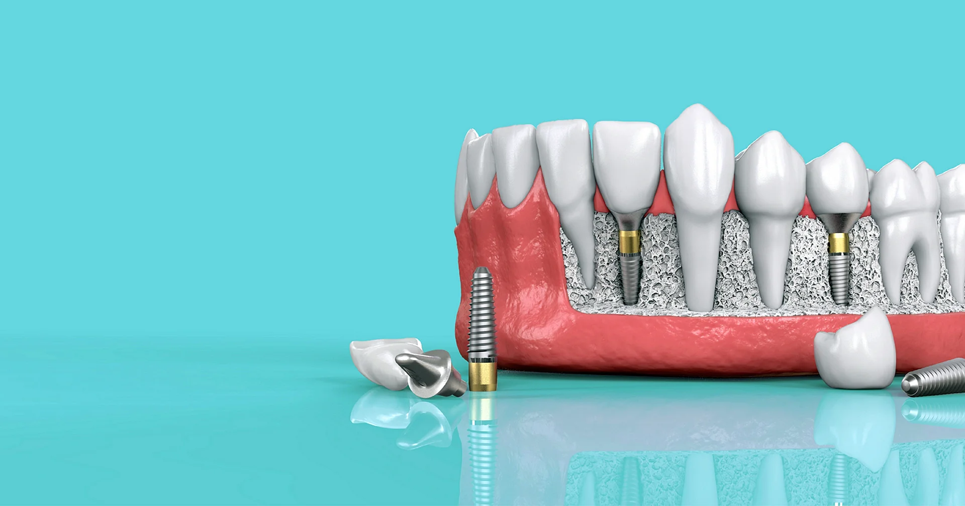 K3 Pro Implant