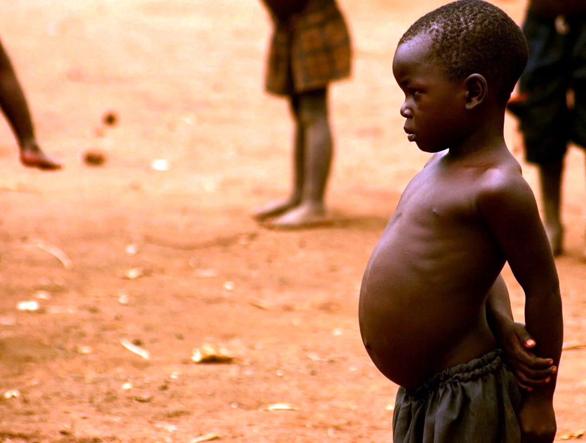 Квашиоркор у детей Африки