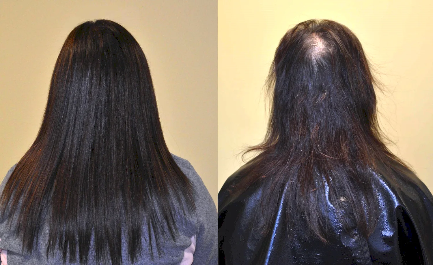 Наращивание волос при алопеции