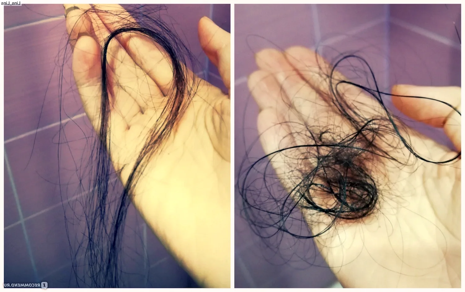 Норма выпадения волос у женщин