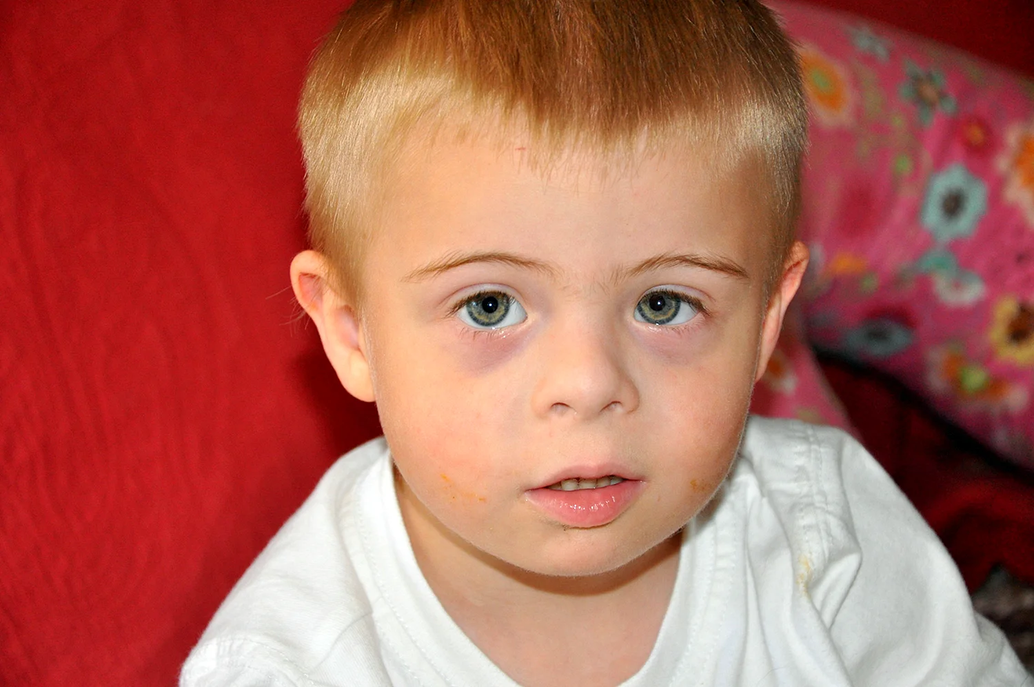 Радужка в глазах у ребенка с синдромом Вильямса