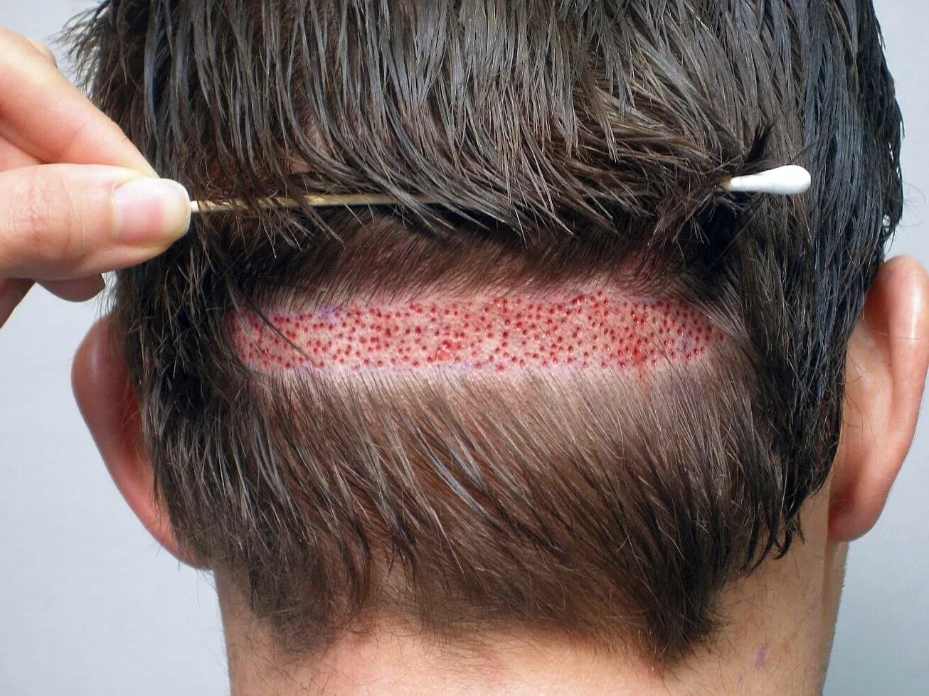 Трансплантация волос на голове