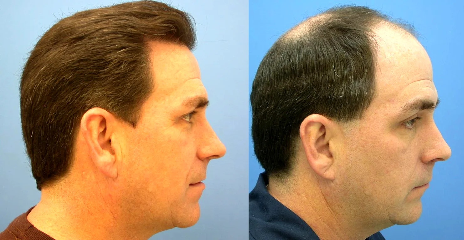 Трансплантация волос у мужчин до и после