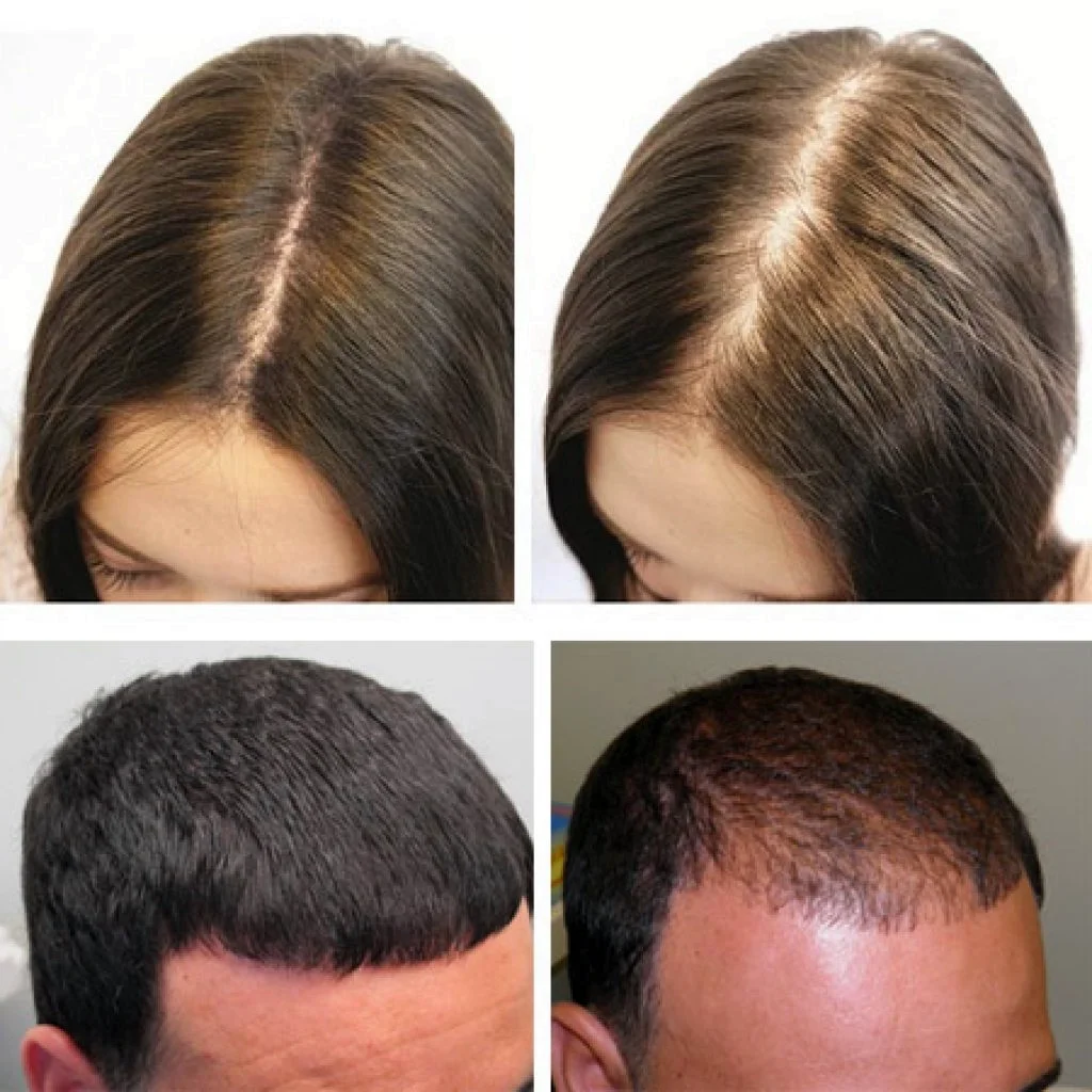 Волосы до и после лысина