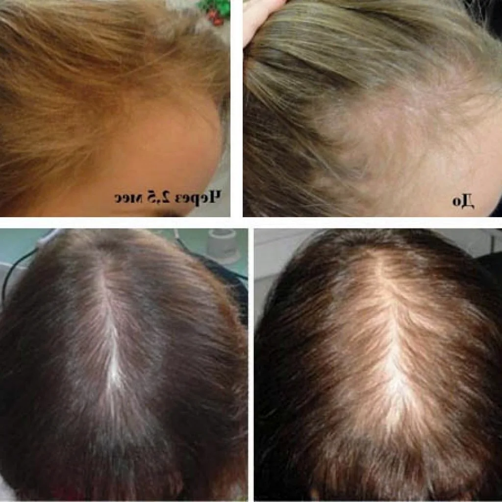 Выпадение волос после маски. Волосы после луковой маски до и после. Волосы до и после витаминов. Касторовое масло для волос до и после. Витамины для роста волос до и после.