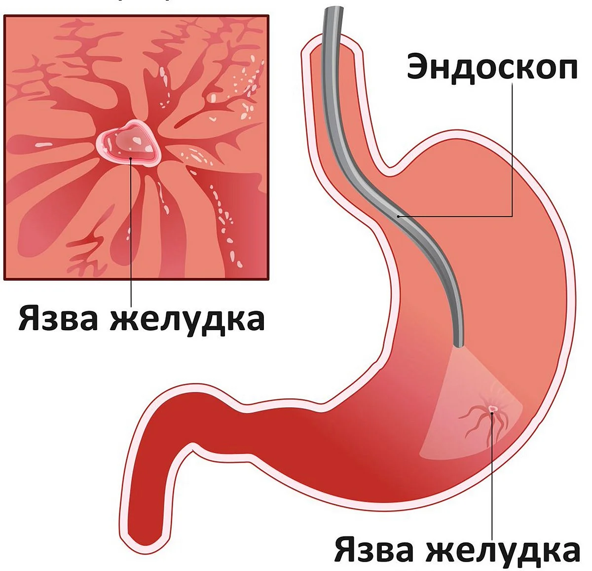 Язвенная болезнь желудка и язва желудка