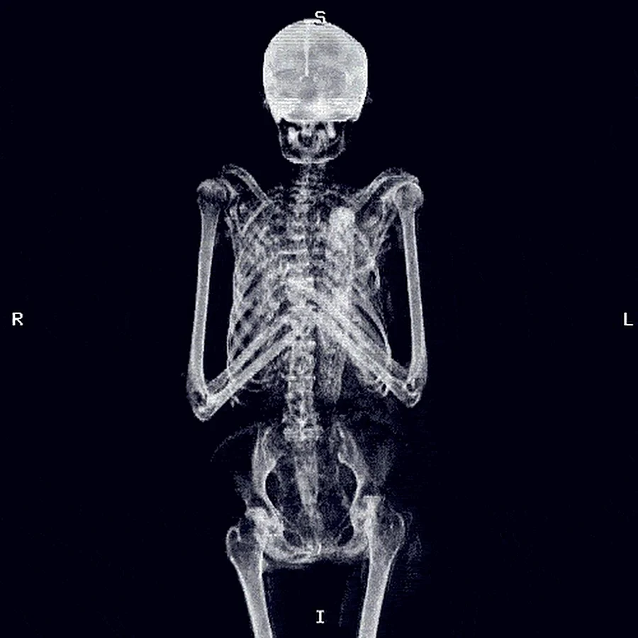 Рентгеновский снимок человека