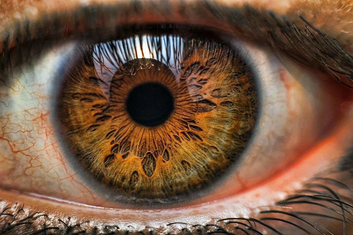 Центральная гетерохромия карих глаз